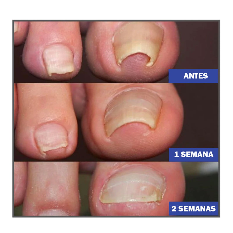 Health&Life™ - Parche de corrección de uñas de los pies